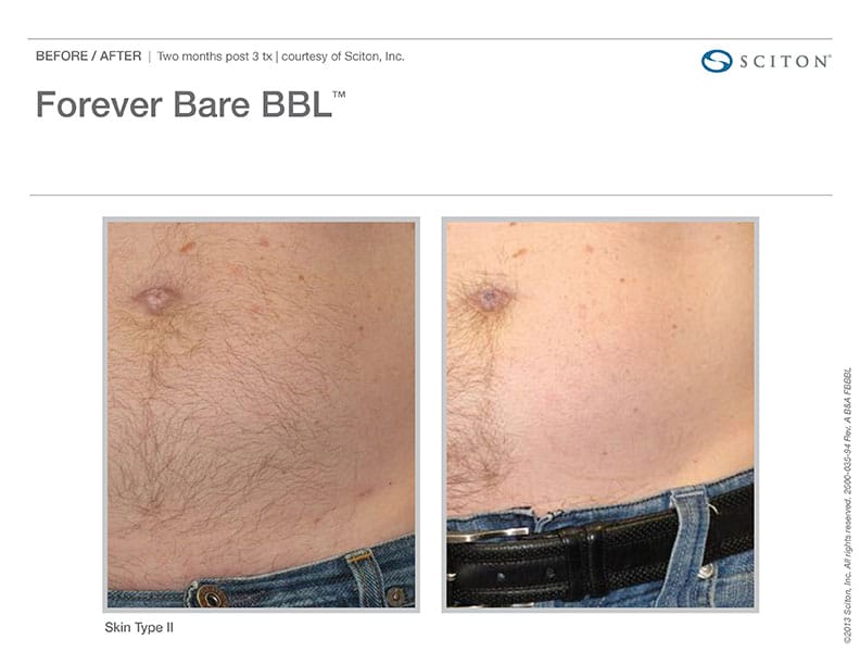 Laser Hair Removal Before And After In West Seattle At Well Medical Arts