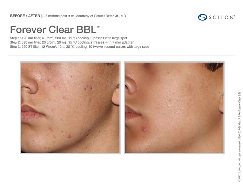 Before And After Images Of Acne Treatment With The Forever Clear BBL At Well Medical Arts