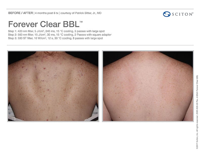 Before And After Images Of Acne Treatment With The Forever Clear BBL At Well Medical Arts