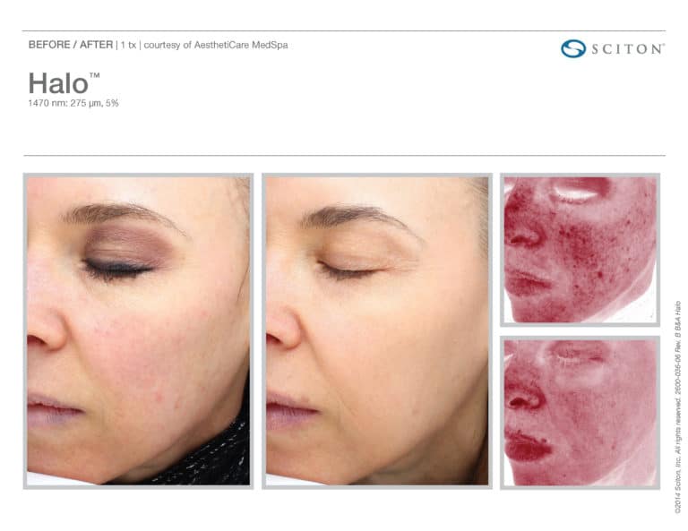 Treat fine lines and wrinkles with the HALO in Seattle at Well Medical Arts
