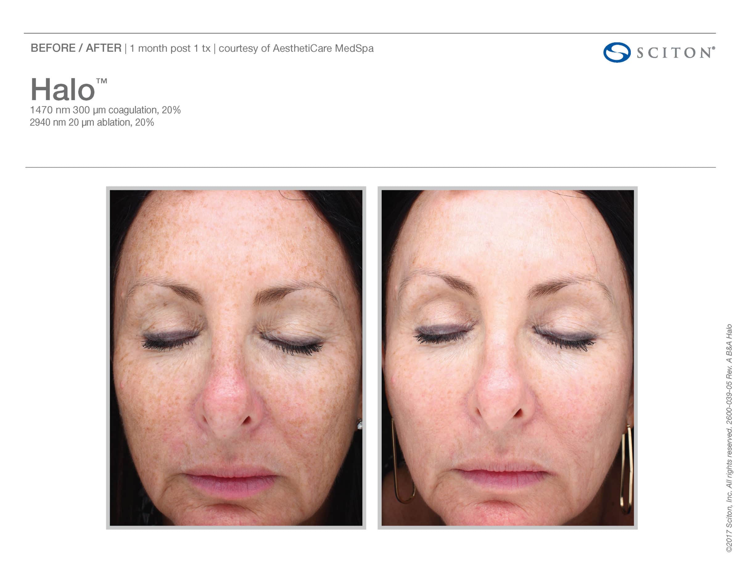 Before And After From Halo Fractional Laser. Halo Is Available At Well Medical Arts In Seattle. Call 206-935-5689 To Schedule Your Treatment Now.