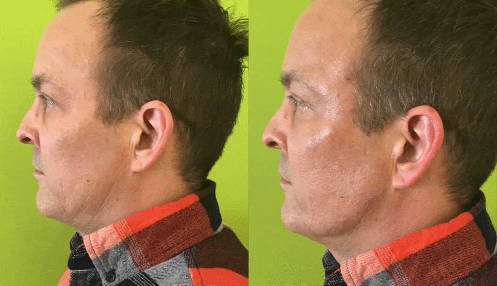 ChiseltheJawlinewithDermallFillersatWellMedicalArts Well