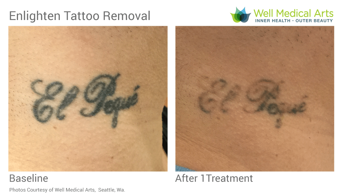 Progress after 25 laser sessions The original tattoo was very black and  very deep  rTattooRemoval