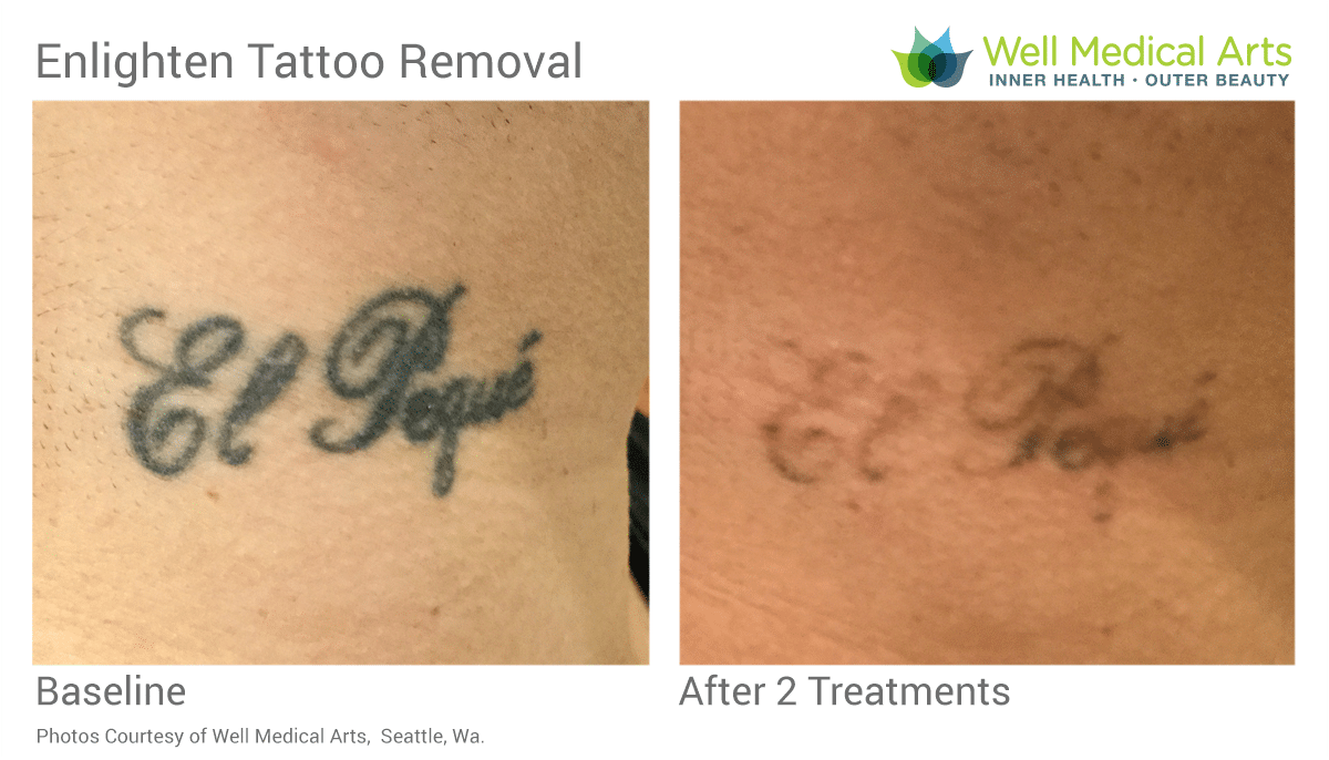 Premier Dermatology  Cosmetic Surgery  Repost from hmashekmd  Tattoo  removal with Cutera Enlighten laser 1064 and 532 nm wavelengths Despite  the popularity of tattoos more than half the people with