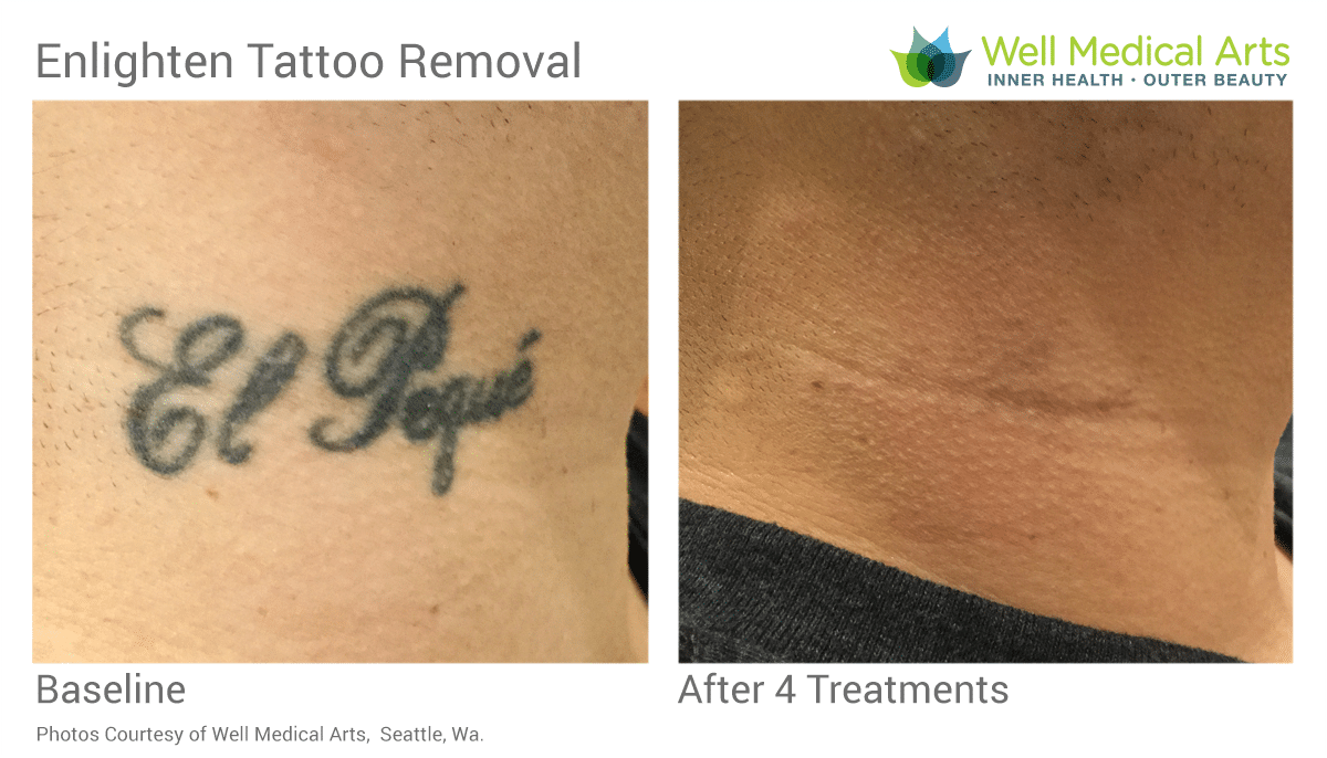 Tattoo Removal Seattle  Tattoo Removal Bellevue