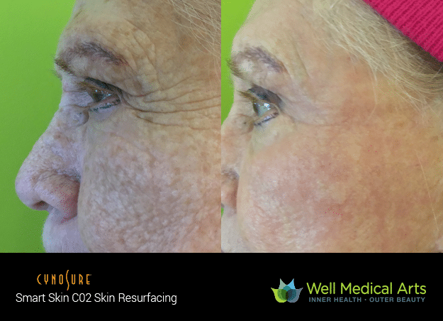 Co2 Fractional Resurfacing Before And After Photos From Well Medical Arts In Seattle.