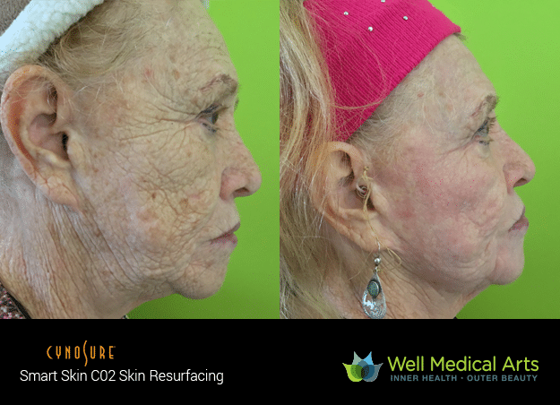 Co2 Fractional Resurfacing Before And After Photos From Well Medical Arts In Seattle.