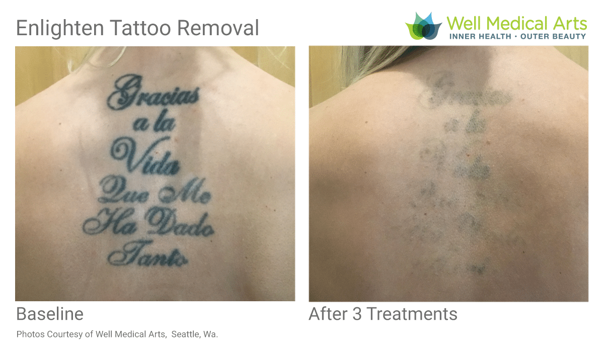 Seattle Skin and Laser  Worried that your tattoo is too dark or too big  for removal We use two different laser technologies to suit a variety of  pigments Give us a