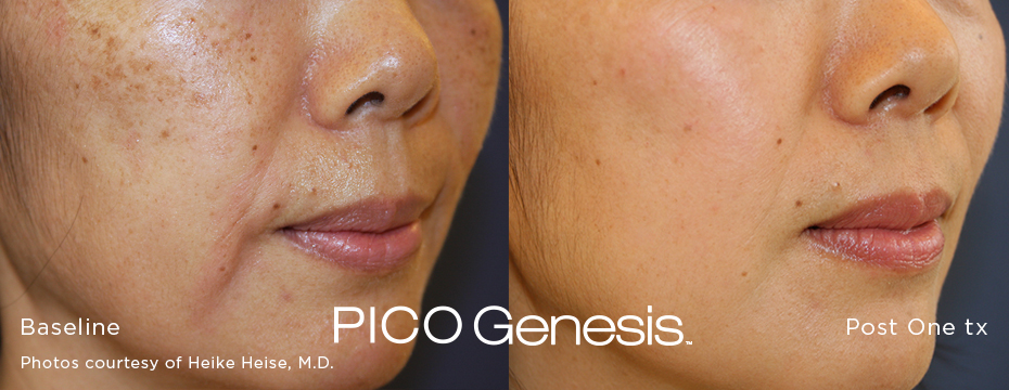 Melasma Before And After Using The Cutera Enlighten Pico Genesis Treatment Protocols.