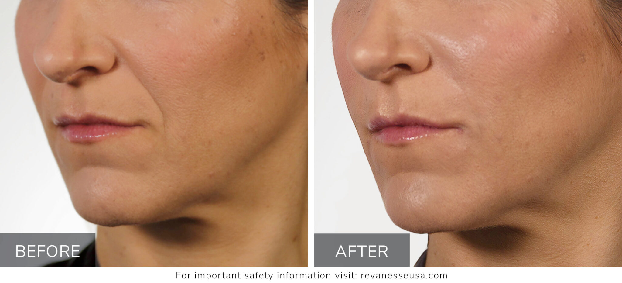 Versa Botox Versa Before and After Seattle 3 - Well Medical Arts: West Seattle's ...