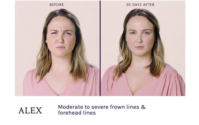 Before and After Botox Frown and forehead Lines Seattle.