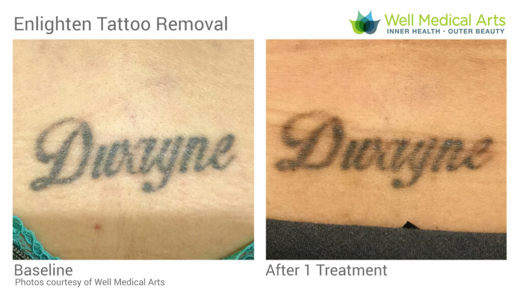 Laser Tattoo Removal Seattle  Removal Cost  Seattle Plastic Surgery