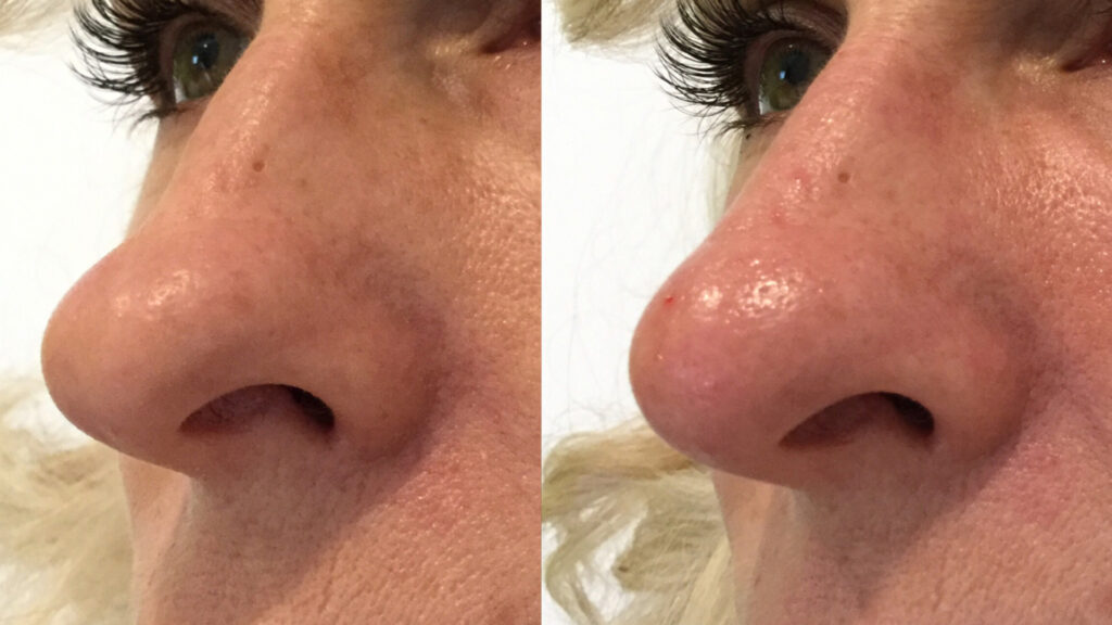 Non Surgical Rhinoplasty, No Downtime and Instant Results using Bellafill at Well Medical Arts. Learn more about the Non Surgical Nose job at Non Surgical Rhinoplasty