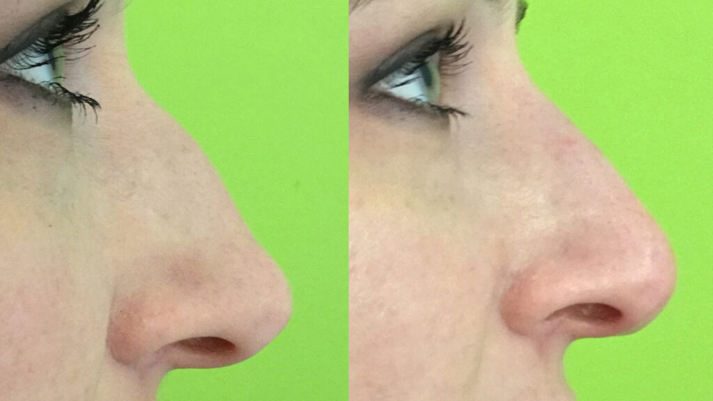 Non Surgical Nose Job with Dermal Filler at Well Medical Arts.
