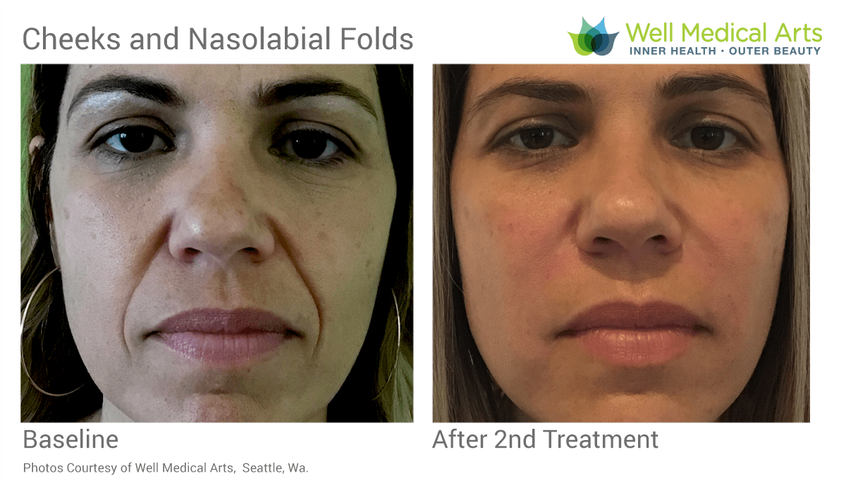 Nasolabial fold (smile lines) and cheek before and after at Well Medica Arts in Seattle