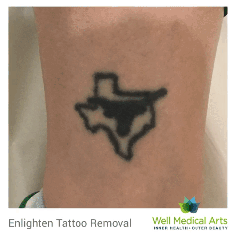 Goodbye Texas. Tattoo removal and lightening in Seattle with the Cutera Enlighten before and after. Call Well Medical Arts at 206-935-5689 to schedule a complimentary consultation or visit us a http://wellmedicalarts.com/seattle-tattoo-removal/ to learn more.