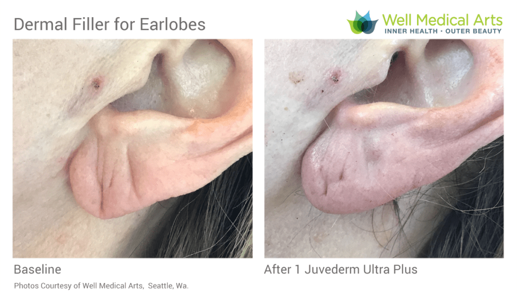 Dermal filler for the correction of aging or sagging earlobe in Seattle at Well medical Arts
