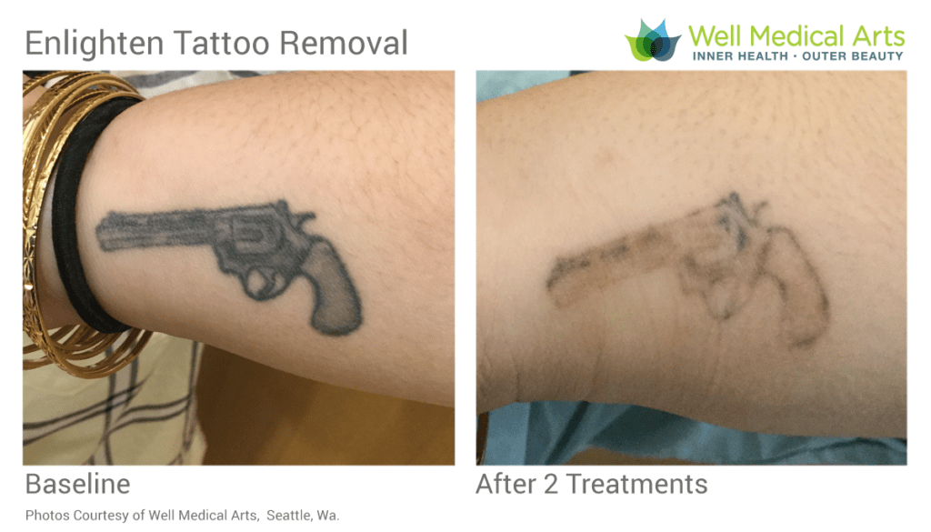 Laser Tattoo Removal Before and After in Seattle at Well Medical Arts