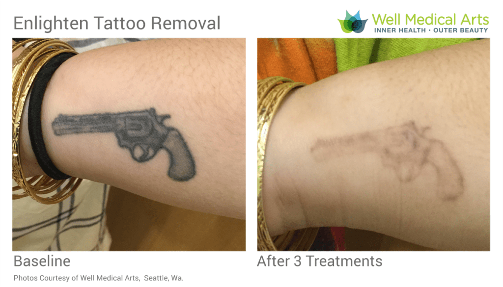 Laser Tattoo Removal Before and After 3 Treatments in Seattle at Well Medical Arts. Learn more about laser tattoo removal in Seattle at https://wellmedicalarts.com/seattle-tattoo-removal/ or call 206-935-5689 for a complimentary consultation.