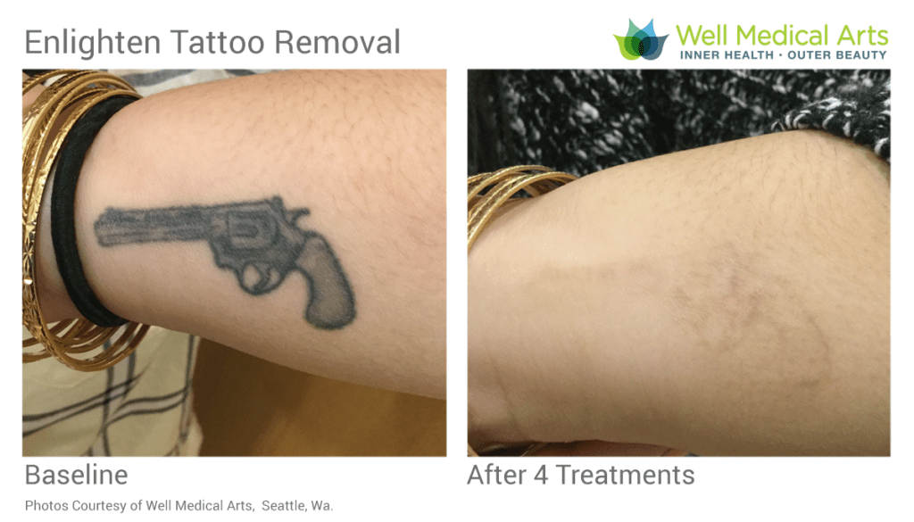 Laser Tattoo Removal Before and After 4 Treatments in Seattle at Well Medical Arts