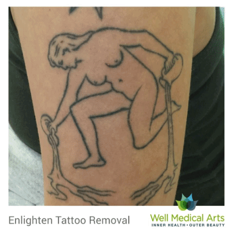 Laser Tattoo Removal Before and After process