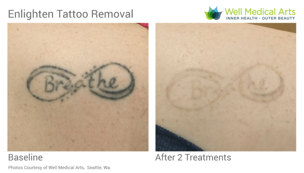 More Cutera Enlighten Before and after goodness after 2 treatments.