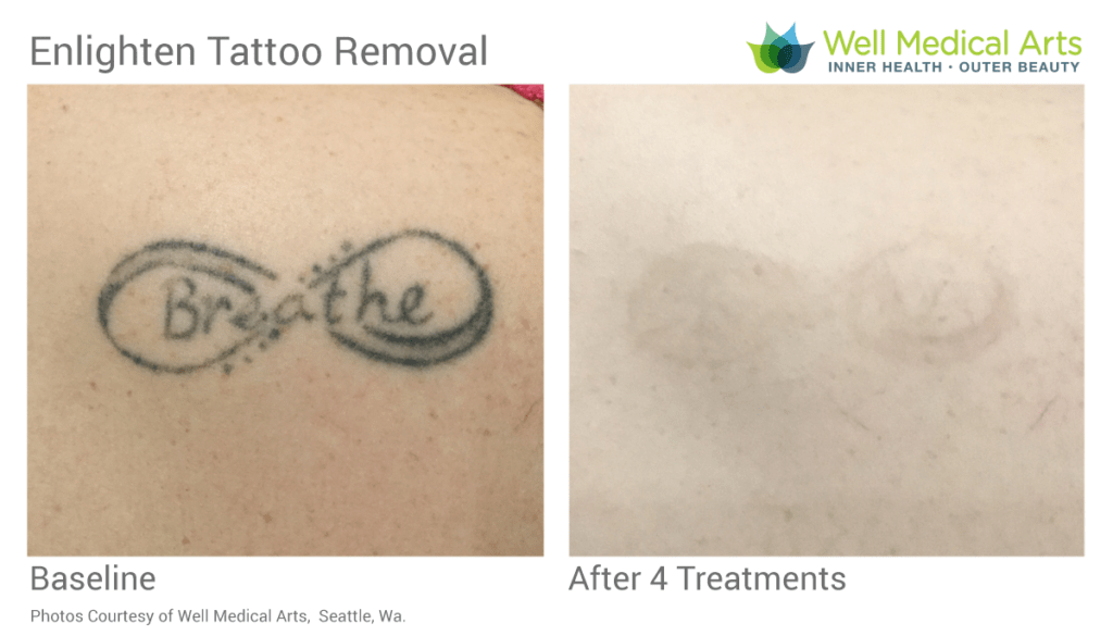 More Cutera Enlighten Before and after goodness. After 4 Treatments
