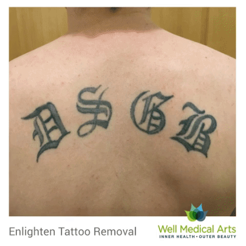 Dang. Tattoo removal and lightening in Seattle with the Cutera Enlighten before and after. Call Well Medical Arts at 206-935-5689 to schedule a complimentary consultation or visit us a http://wellmedicalarts.com/seattle-tattoo-removal/ to learn more.