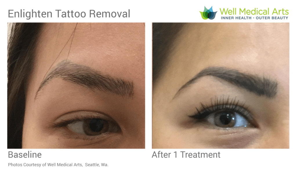 Microblading removal before and after in Seattle at Well Medical Arts after 1 treatment