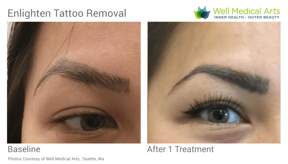 Cosmetic Laser Tattoo Removal Expert Victoria Bianco Beauty