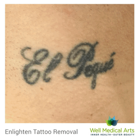 Neck Tattoo Removal with Cutera Enlighten before and after