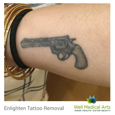 No Guns allowed. Tattoo removal and lightening in Seattle with the Cutera Enlighten before and after. Call Well Medical Arts at 206-935-5689 to schedule a complimentary consultation or visit us a http://wellmedicalarts.com/seattle-tattoo-removal/ to learn more.