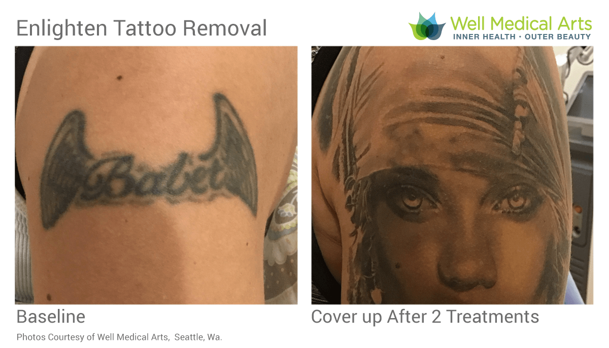 Gain awesome new ink with a tattoo cover up  Tattoo Removal