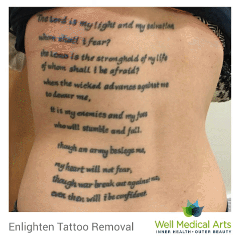 No Longer there. Tattoo removal and lightening in Seattle with the Cutera Enlighten before and after. Call Well Medical Arts at 206-935-5689 to schedule a complimentary consultation or visit us a http://wellmedicalarts.com/seattle-tattoo-removal/ to learn more.