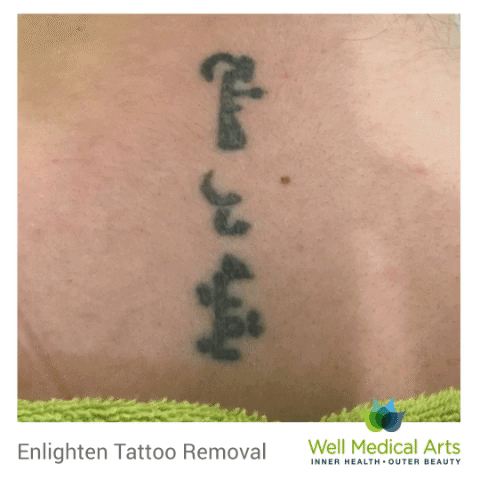 Don't look back. Tattoo removal and lightening in Seattle with the Cutera Enlighten before and after. Call Well Medical Arts at 206-935-5689 to schedule a complimentary consultation or visit us a http://wellmedicalarts.com/seattle-tattoo-removal/ to learn more.