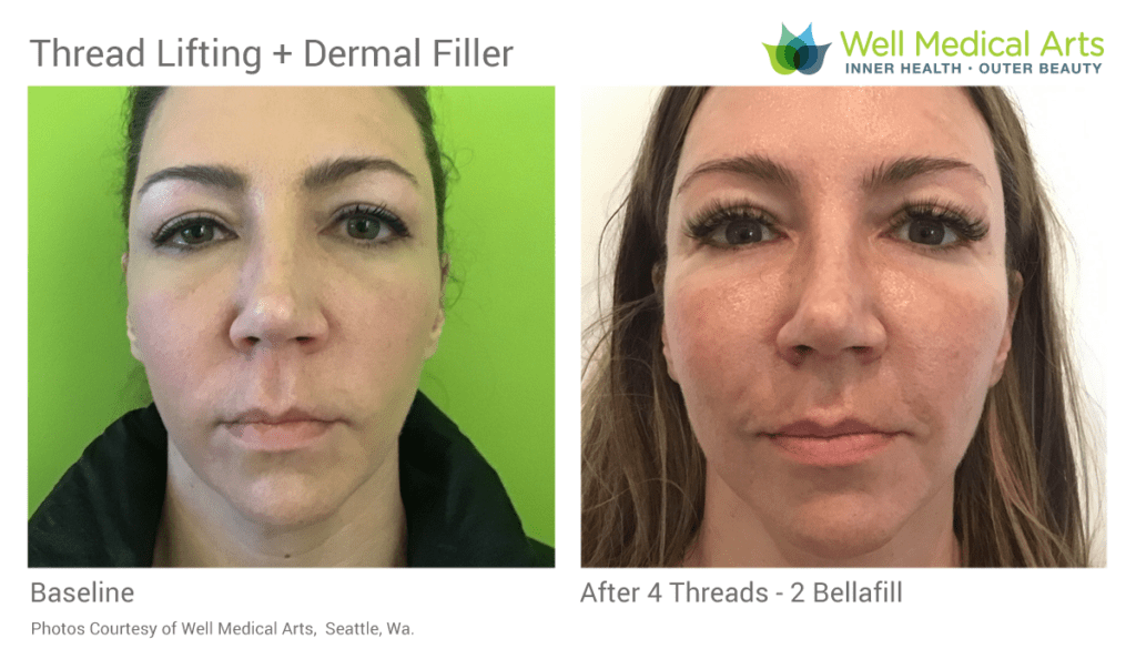 Thread Lifting using PDO Threads Before and After in Seattle at Well Medical Arts