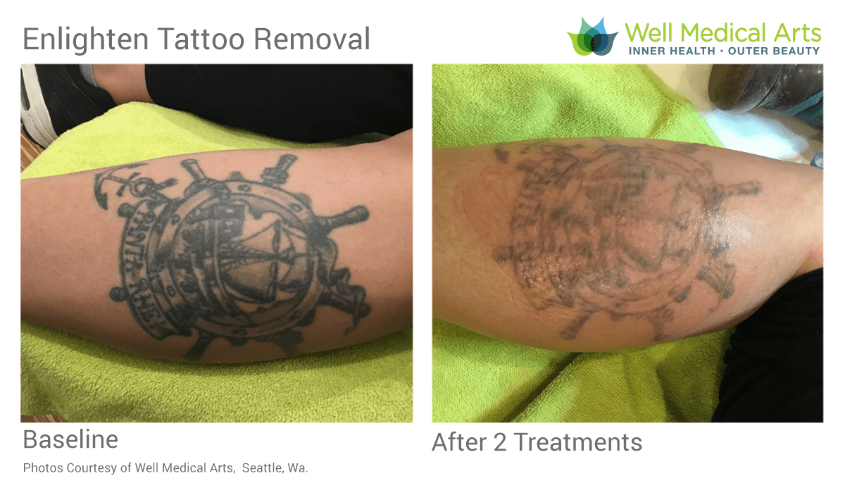 Tattoo Removal in Seattle using Pico Technology at Well