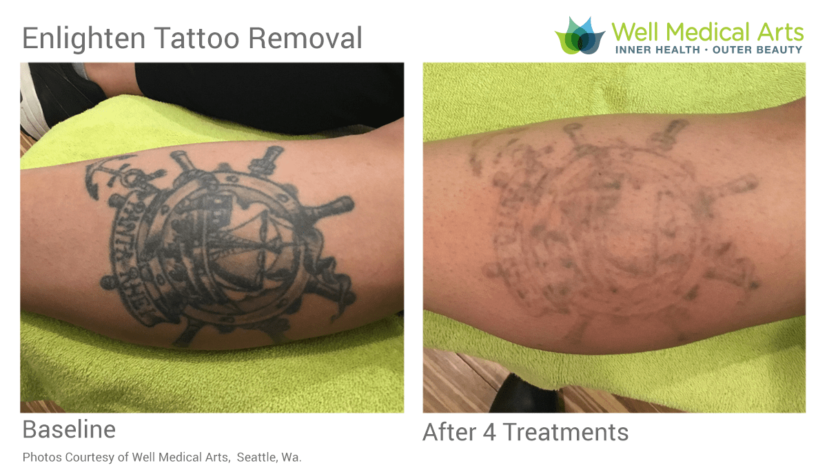 Tattoo Removal in Seattle using Pico Technology at Well Medical Arts