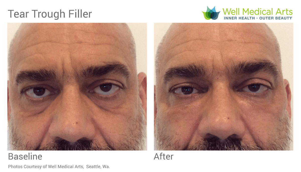 Tear Trough Filler Before And After In Seattle At Well Medical Arts. Learn More About Tear Trough Filler At Tear Trough Treatment (Black Bags Under Eyes)
