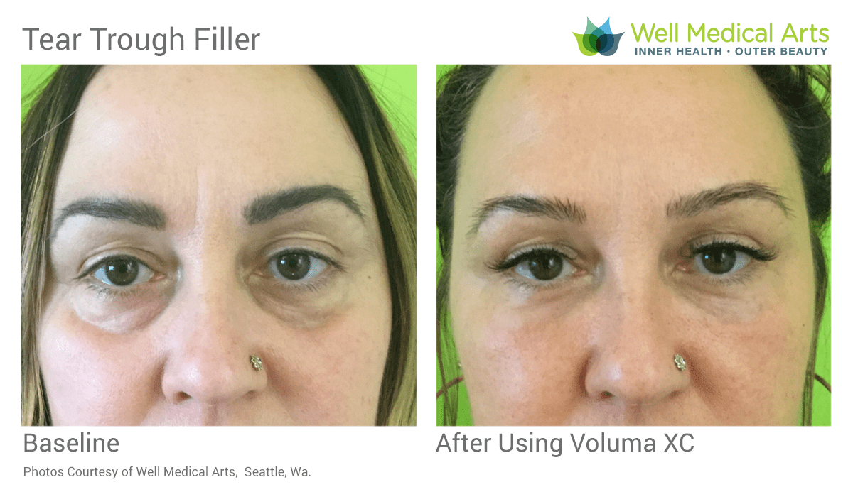 Tear Trough Filler Before And After In Seattle At Well Medical Arts. Learn More About Tear Trough Filler At Tear Trough Treatment (Black Bags Under Eyes)