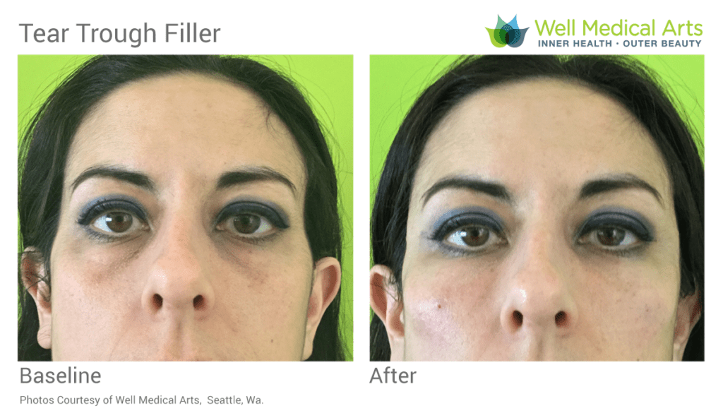 Tear trough filler before and after in Seattle at Well Medical Arts. Learn more about tear trough filler at Tear Trough Treatment (Black Bags under eyes)