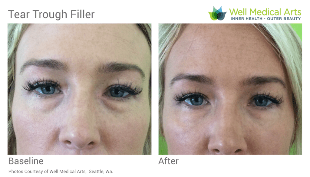 Under eye filler before and after at Well Medical Arts in Seattle