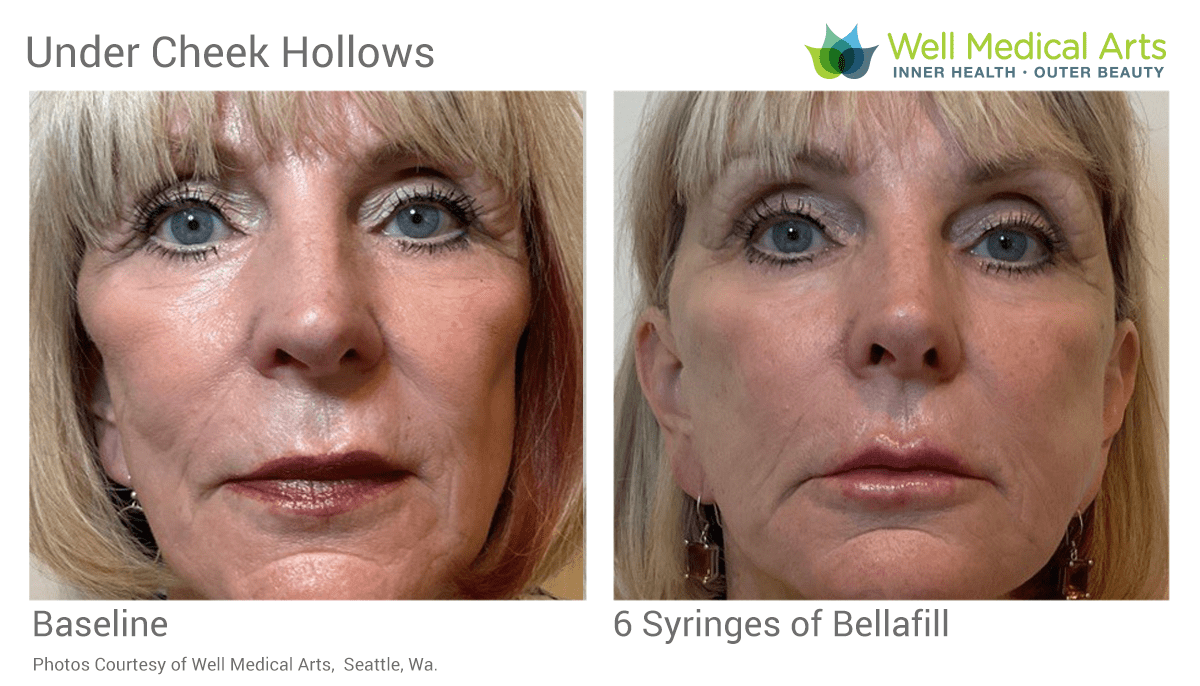 Bellafill is a great choice for filling the under cheek hollows. See the Before and Afters