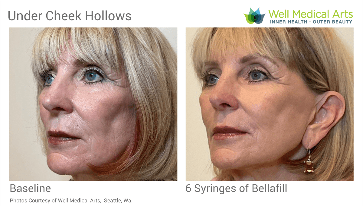 Bellafill is a great choice for filling the under cheek hollows.