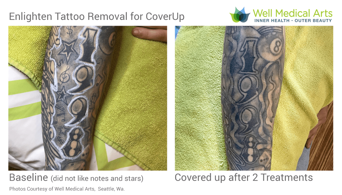 Tattoo Removal Before And After Lighten For COVERUP