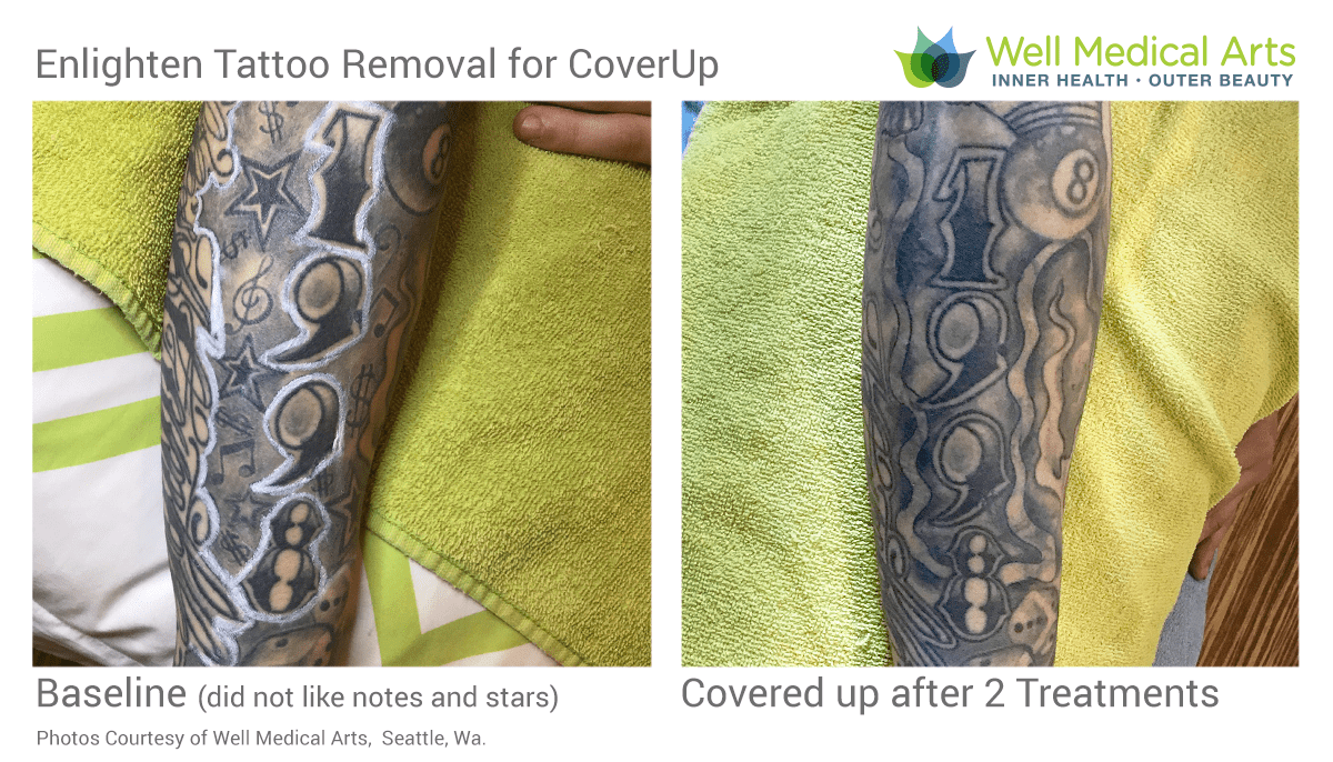 Pinkwork Advanced Aesthetics MAIN Branch  TATTOO AND MELASMA REMOVAL with  ND Yag Laser  Getting tattoos can be regretful sometimes but no worries  as Pinkworks tattoo removal service will help you