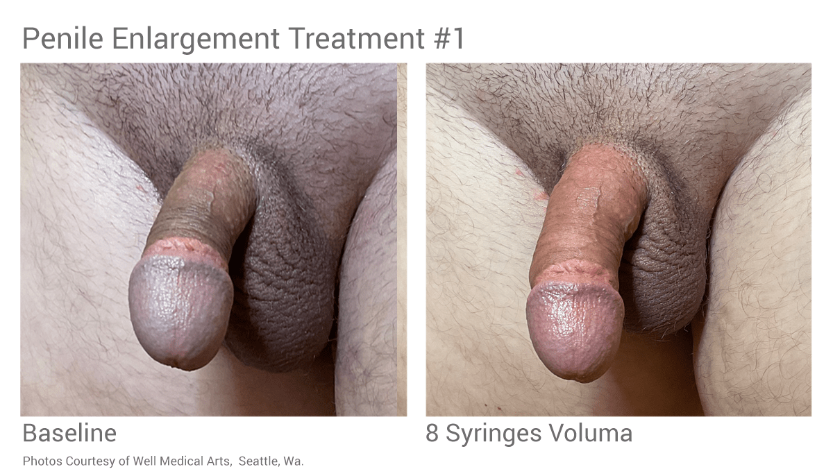 Non-surgical Penis Enlargement with Dermal Filler before and after treatment #1 in Seattle at Well Medical Arts