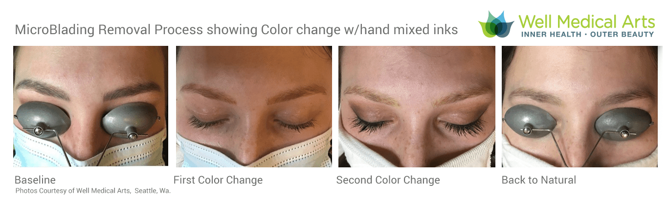 Microblading and cosmetic tattoo removal with hand mixed colors. This image shows the process of possible color changes during a series of treatments.