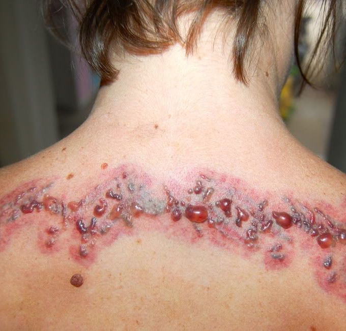 Tattoo Removal Healing Process - Well Medical Arts: Seattle's Anti-Aging  Clinic