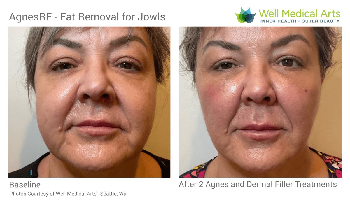 Agnes RF Is A Great Choice For Melting Away Fat From The Jowls. It's Great Nasolabial Folds As Well. Call Well Medical Arts At 206-935-5689 To Learn More.
